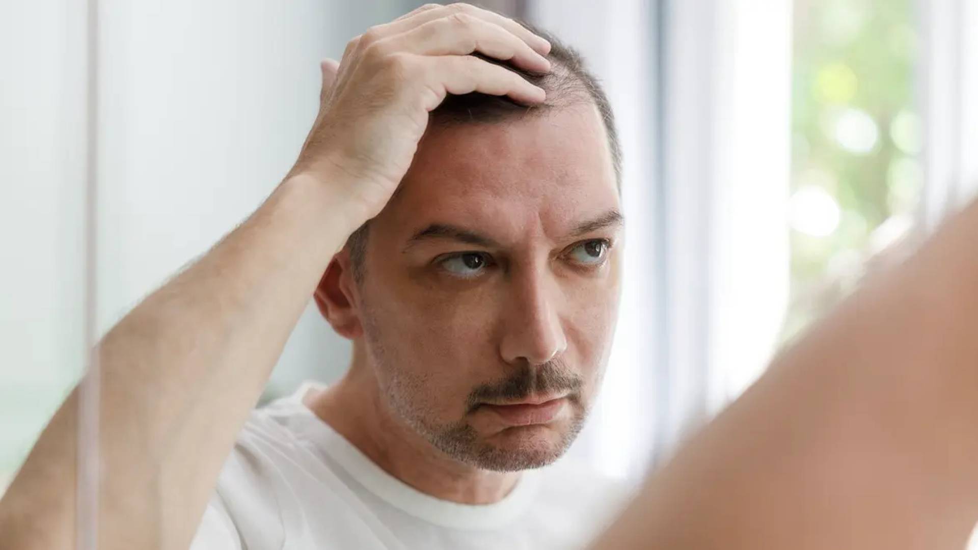 الصلع - تعبيرية