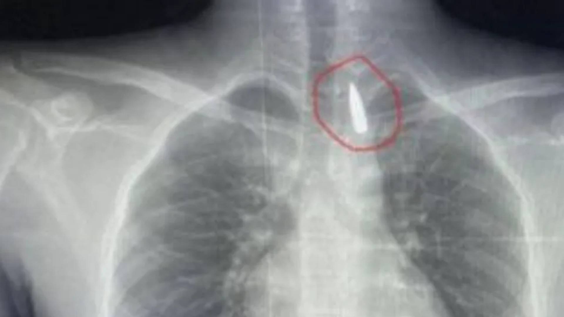 انجاز طبي عالمي.. طواقم طبية مصرية تنجح باستخراج مقذوف استقر قرب الشريان الأورطي لمصاب من غزة