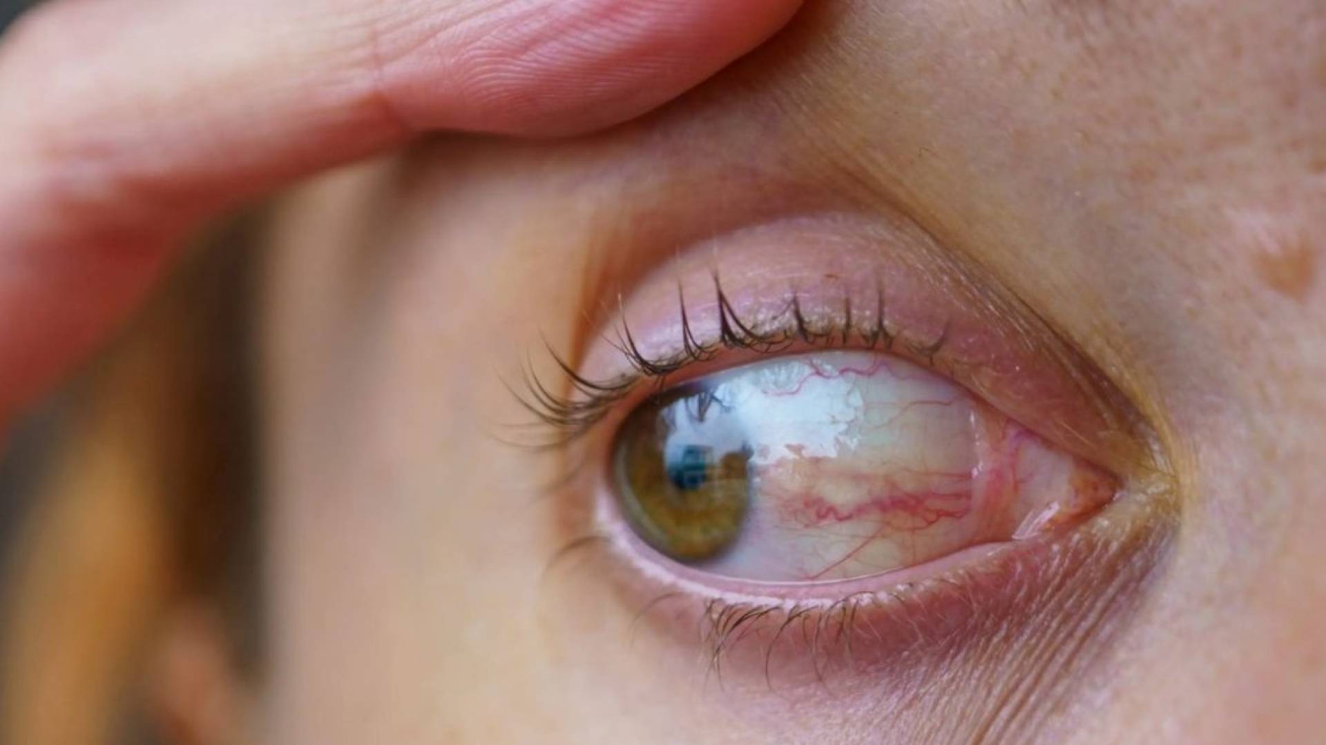 عيون مصابة بمرض "أرشيفية"