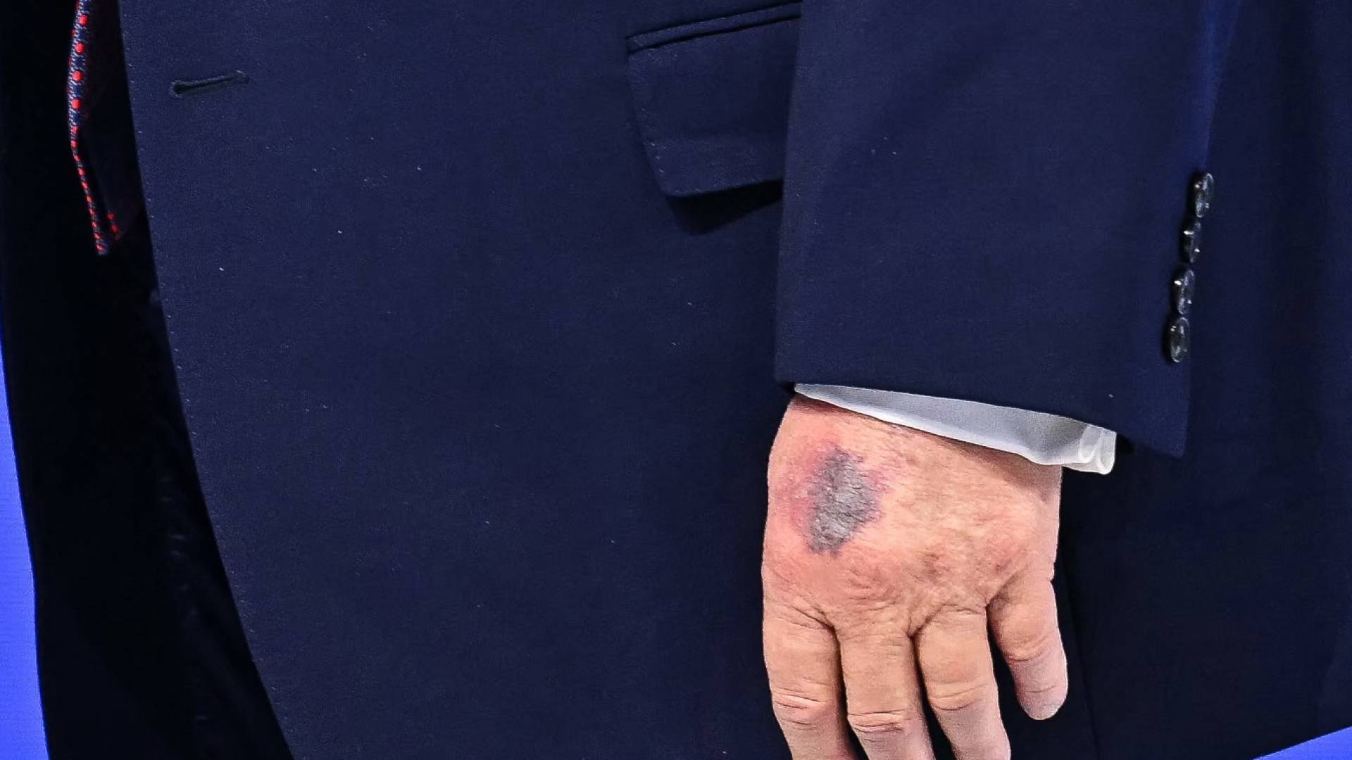 كدمة على يد الرئيس الأمريكي دونالد ترمب