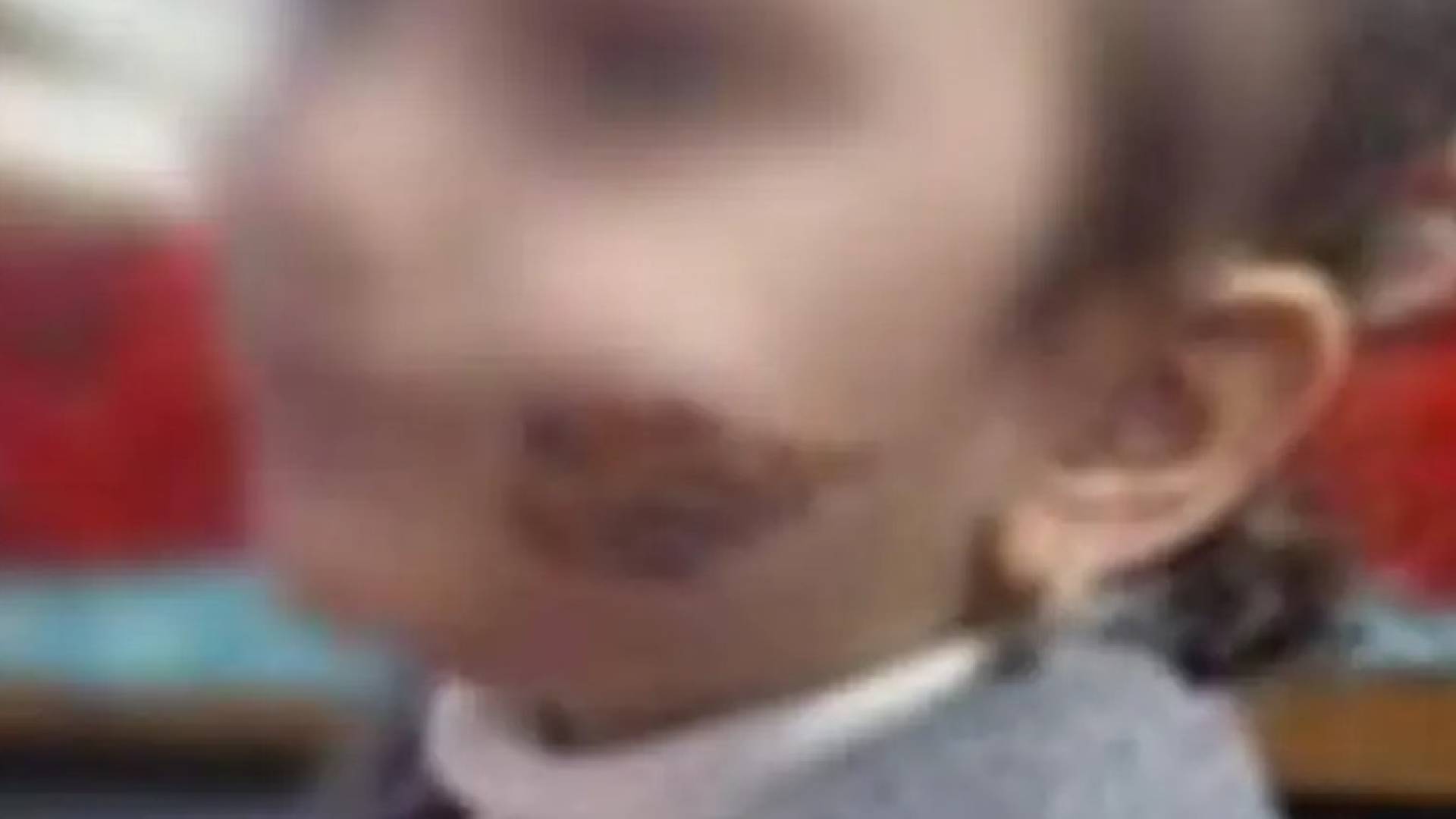 وجه الطفلة الضحية - قامن الأم بتشويه وجهها