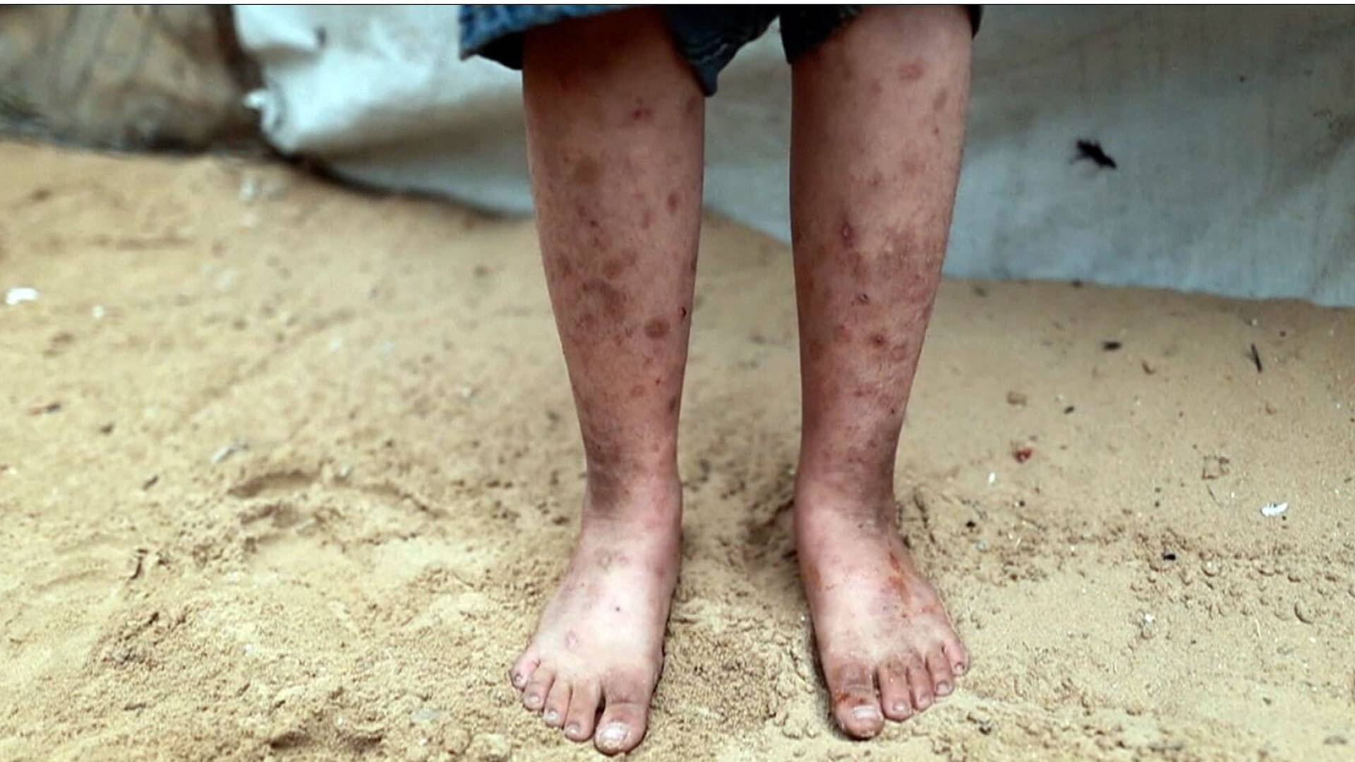 طفل مصاب بأمراض جلدية