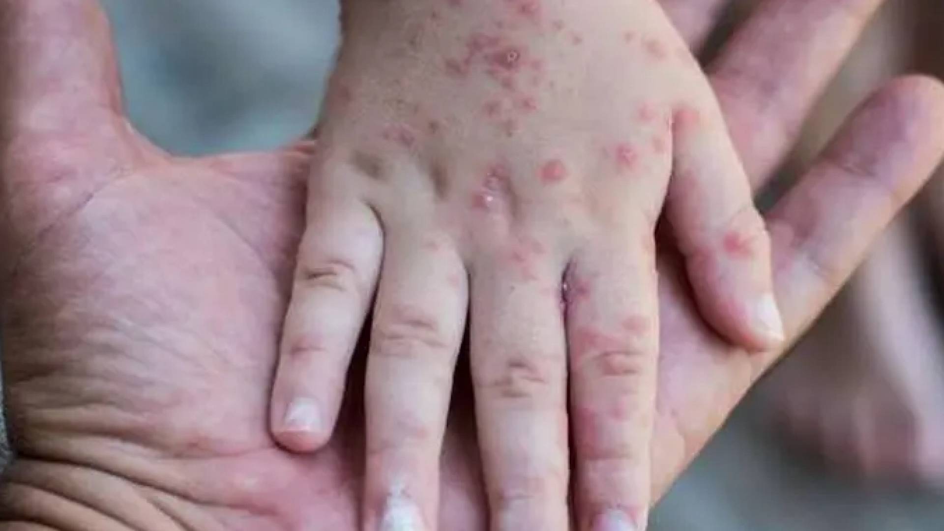 الجدري المائي