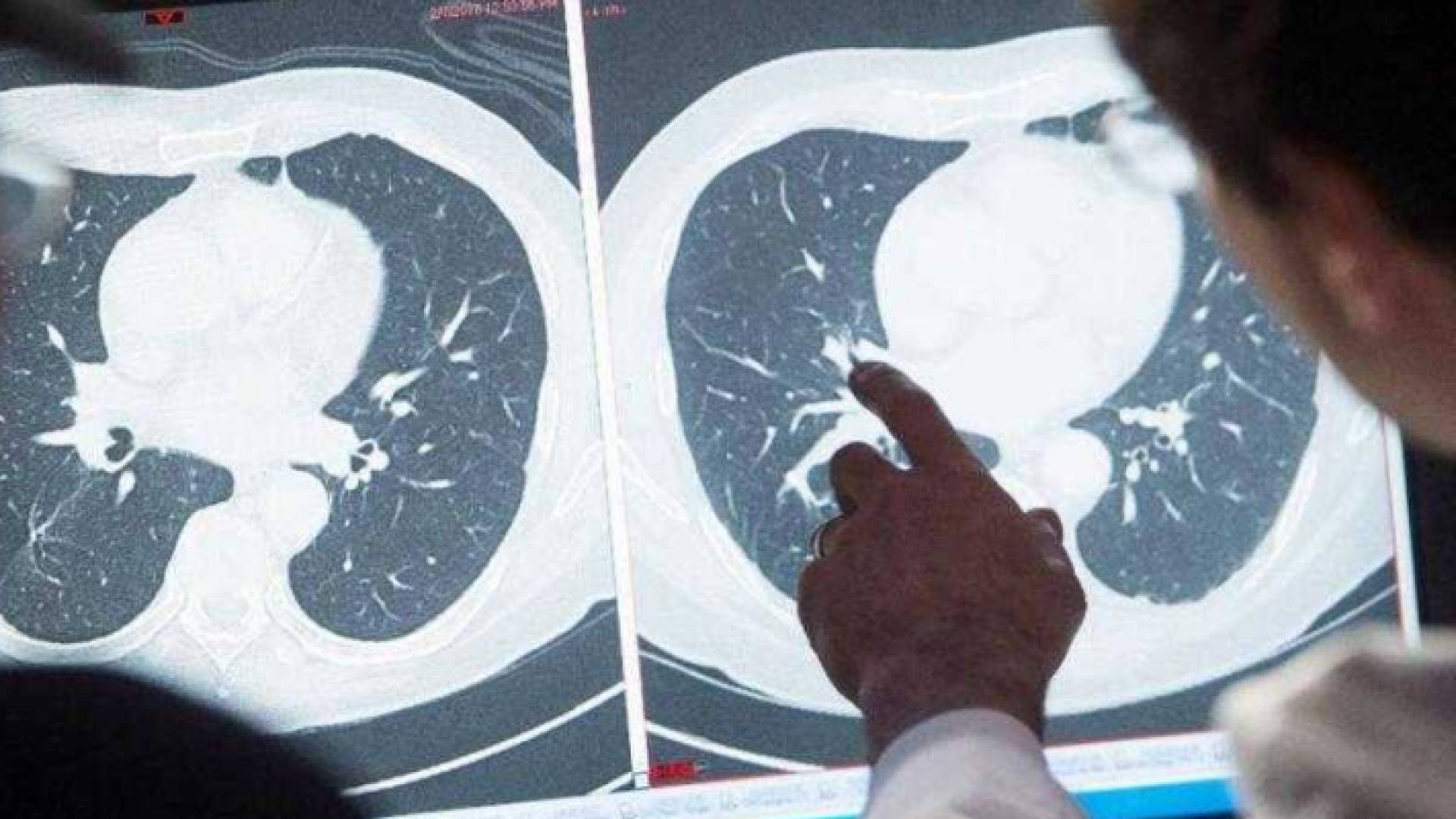 يعتقد أن البويضات انتقلت إلى دماغ الطفلة عبر مجرى الدم من المعدة