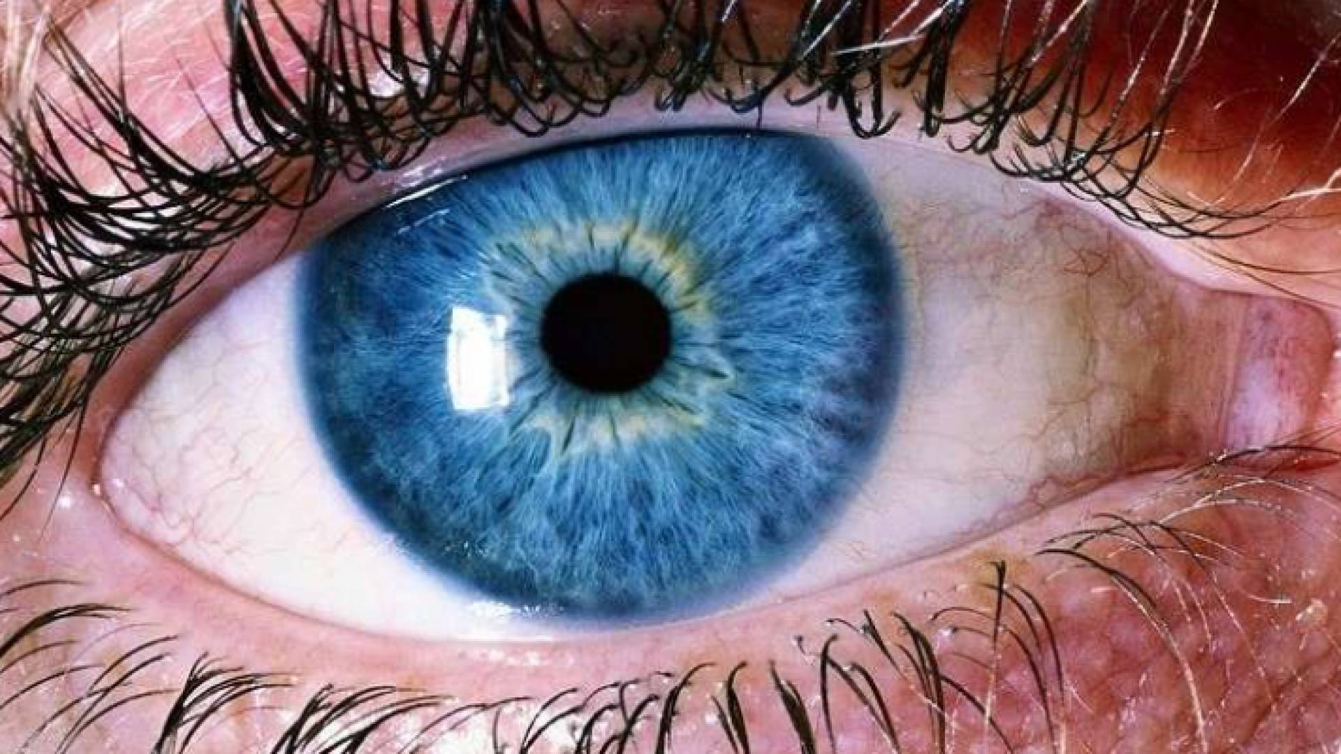 علماء يحذرون من زهري العيون المؤدي لفقدان البصر
