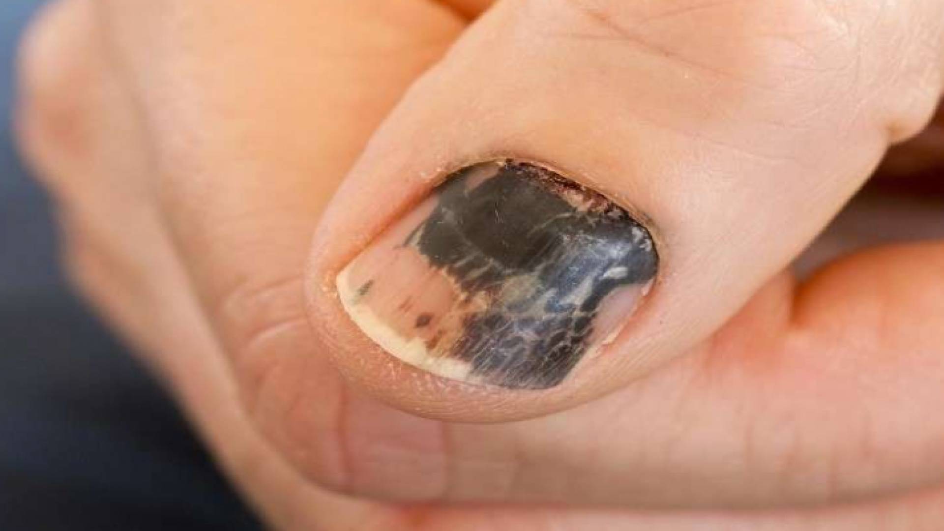 الأظافر تساعد في تشخيص السرطان