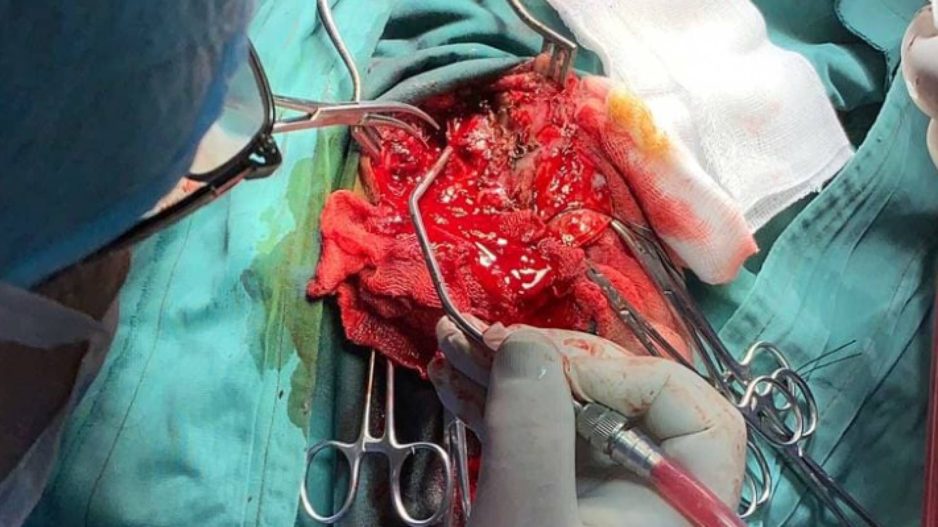 عملية طارئة لشاب تعرض لضربة صاروخ يدوي في مستشفى الزرقاء