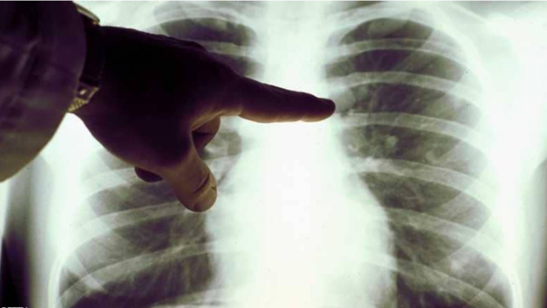 تناول بعض الأغذية بإفراط يزيد من خطر الإصابة بسرطان الرئة