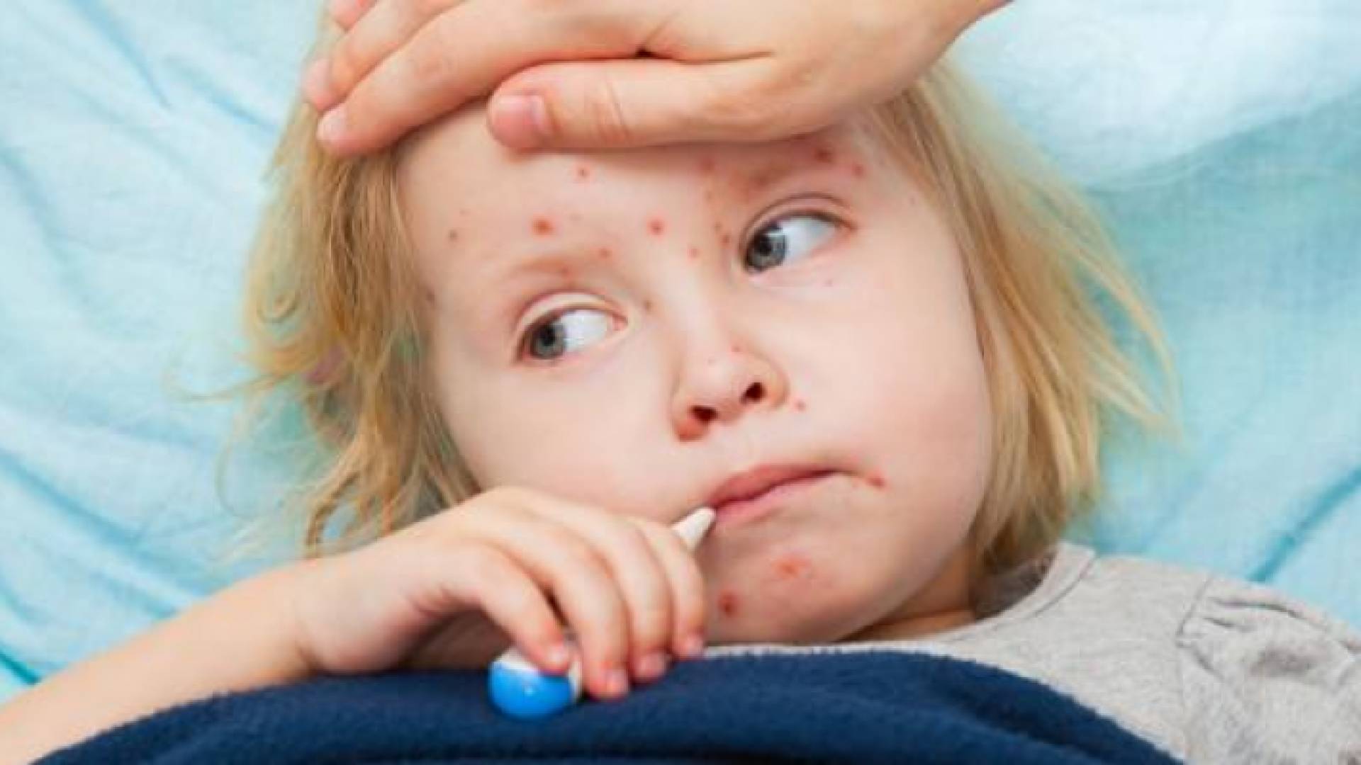 مرضى الحصبة - ارشيفية