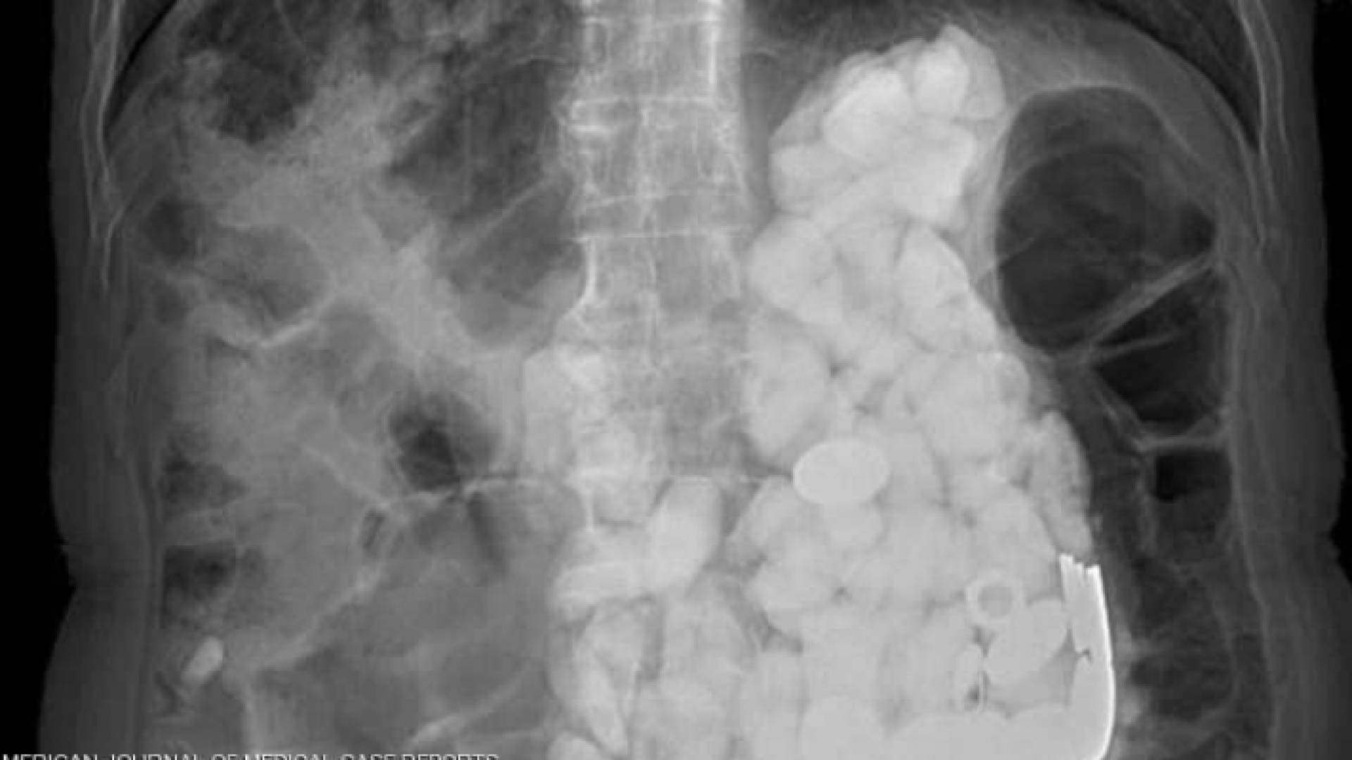 رجل يصدم الأطباء بـ"مقتنيات غريبة" في معدته