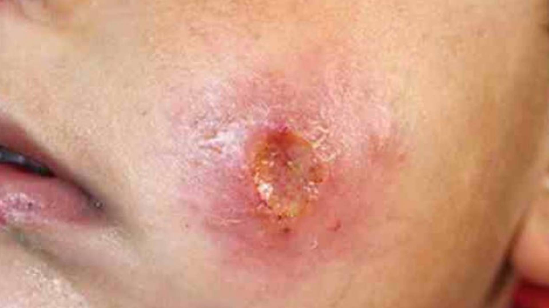 داء اللشمانيا - ارشيفية