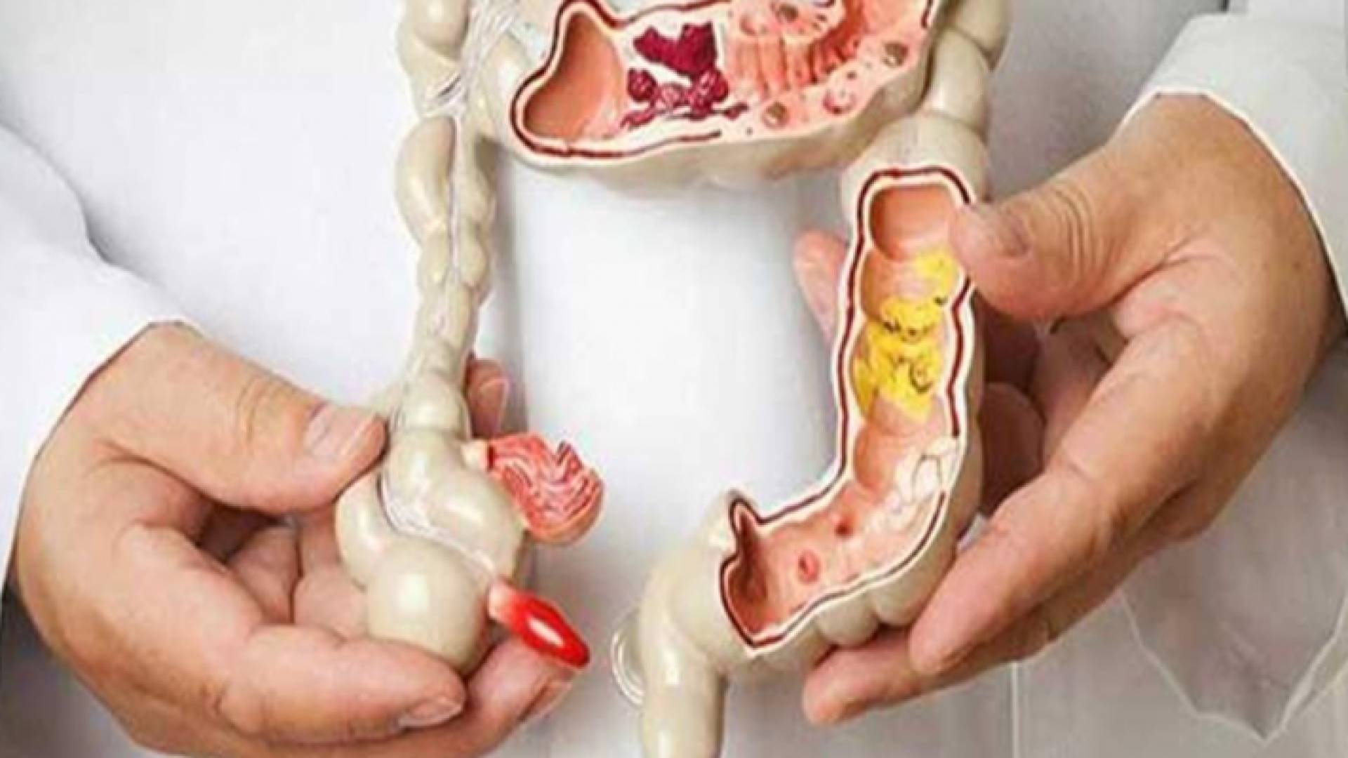 سرطان القولون يعد ثاني أكثر السرطانات المسببة لوفيات السرطان في الأردن بحسب مركز الحسين للسرطان - تعبيرية