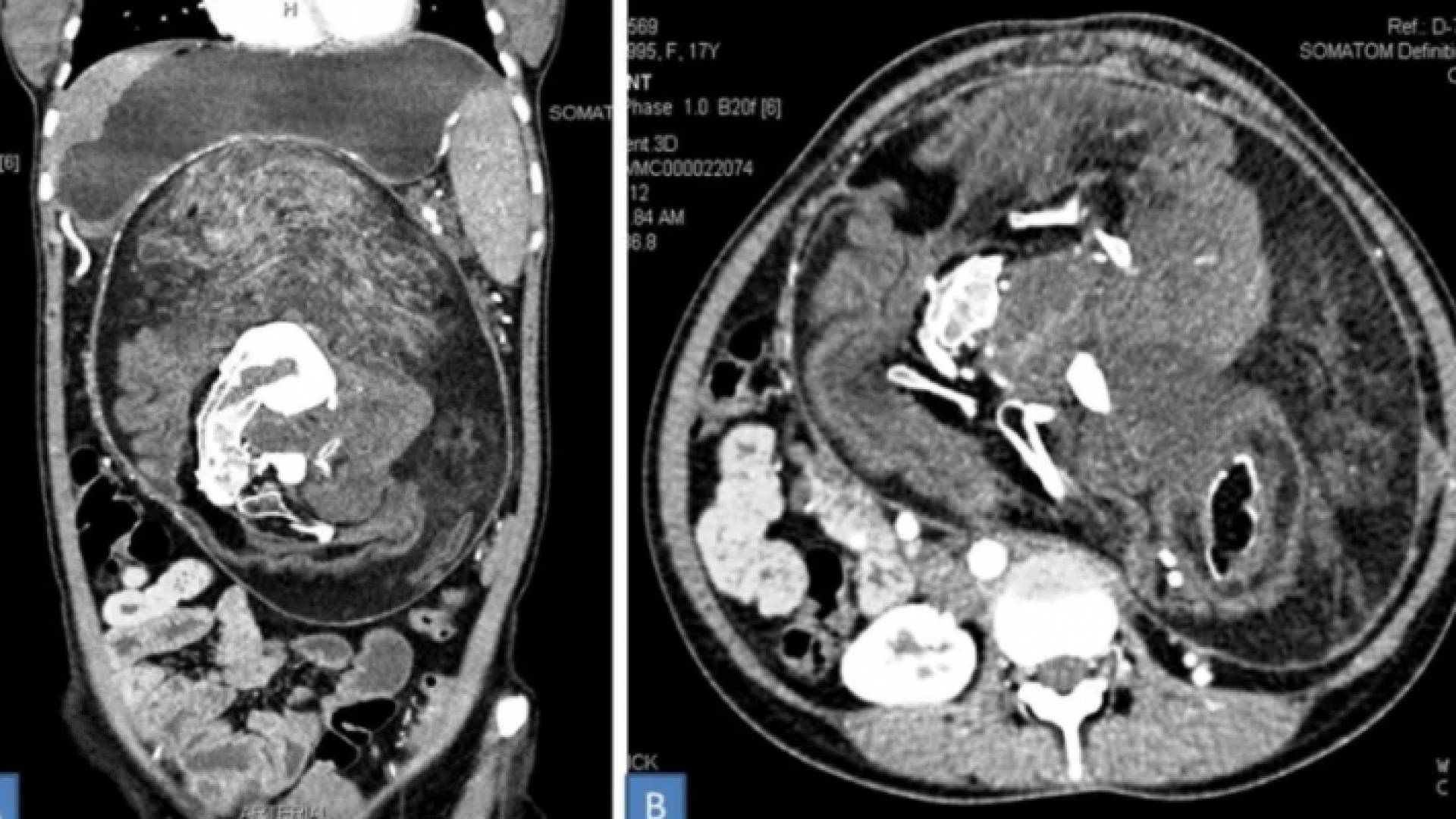 فحص بالأشعة المقطعية للجنين الموجود داخل بطن المرأة