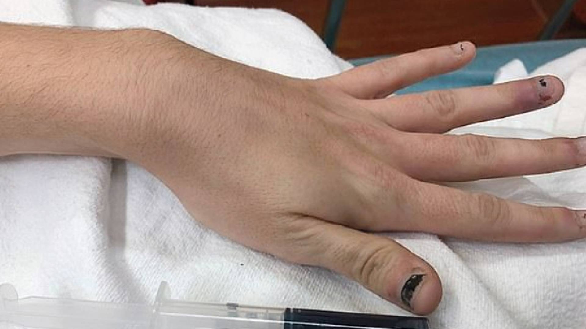 صدمة للأطباء فتاة يتحول دمها للون الأزرق