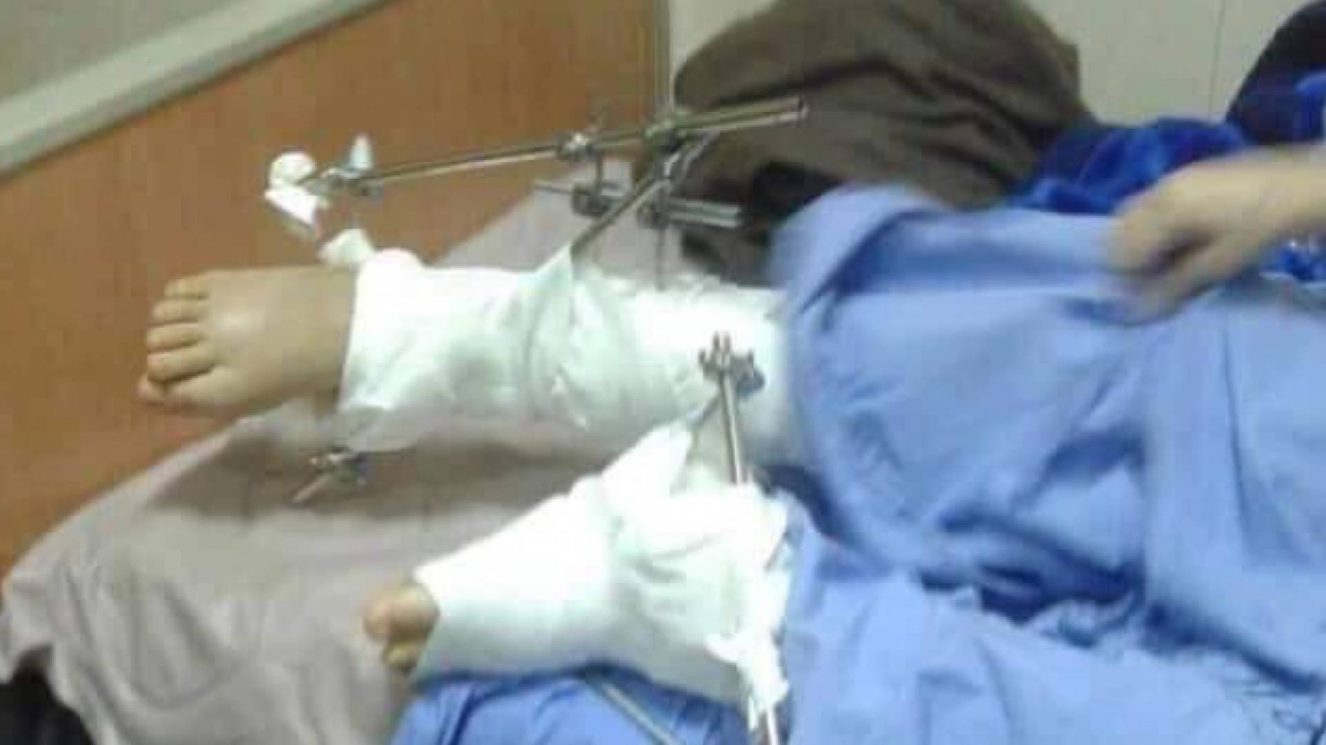 صورة متداولة لأقدام الشابة المصابة