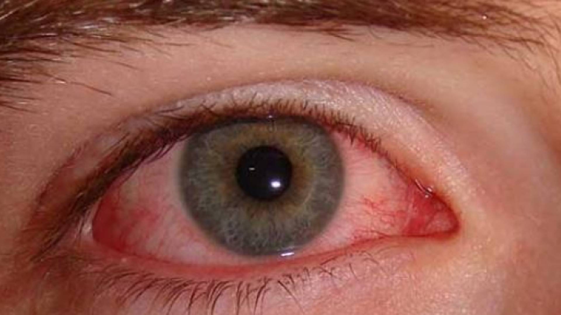 ابرة الكورتيزون تقلل من أعراض الحساسية ولا تعالجها ولها أعراض خطيرة ويجب استشارة الطبيب