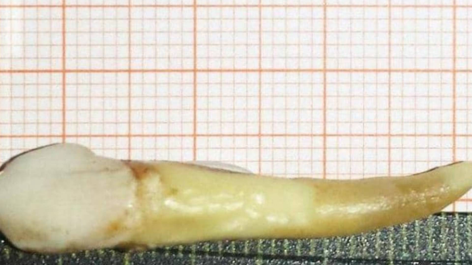 طول السن بلغ 3.72 سنتيمتر