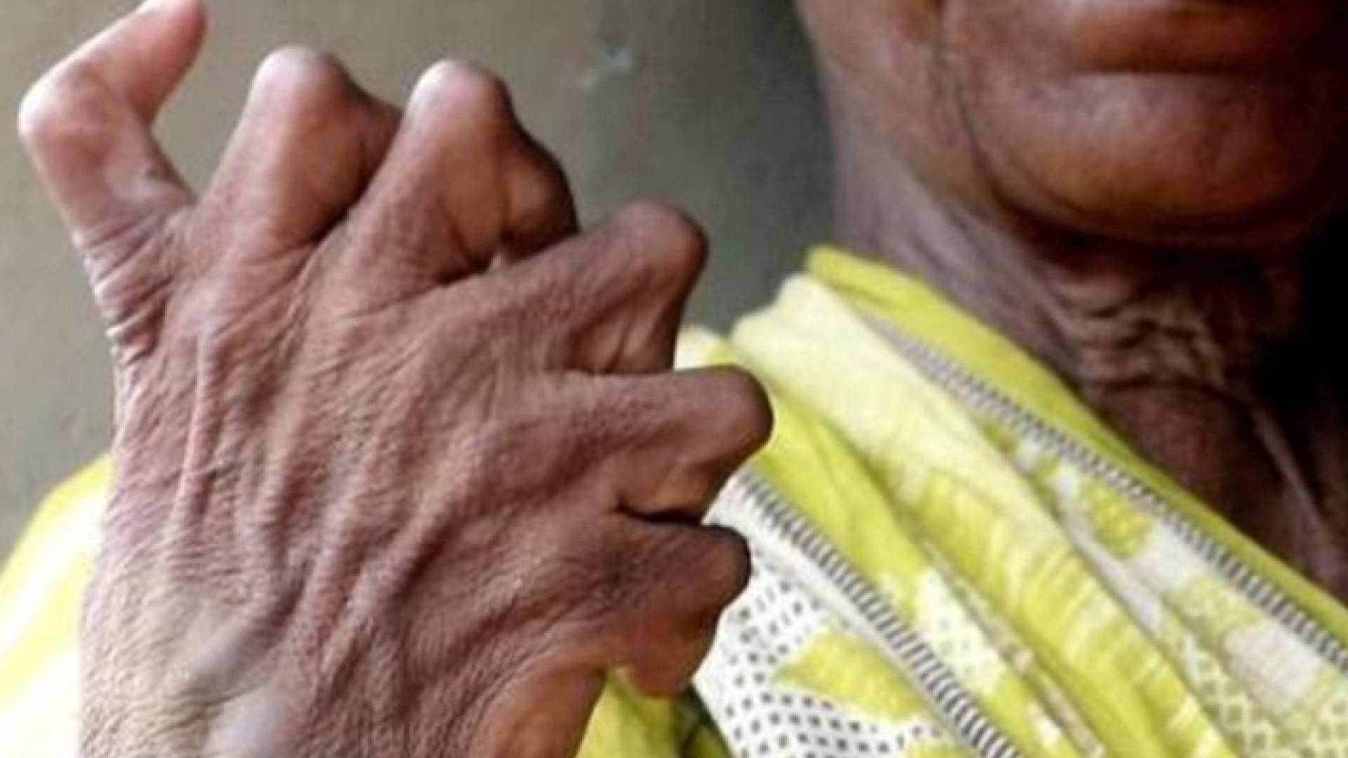 المرأة "ذات الأصابع"