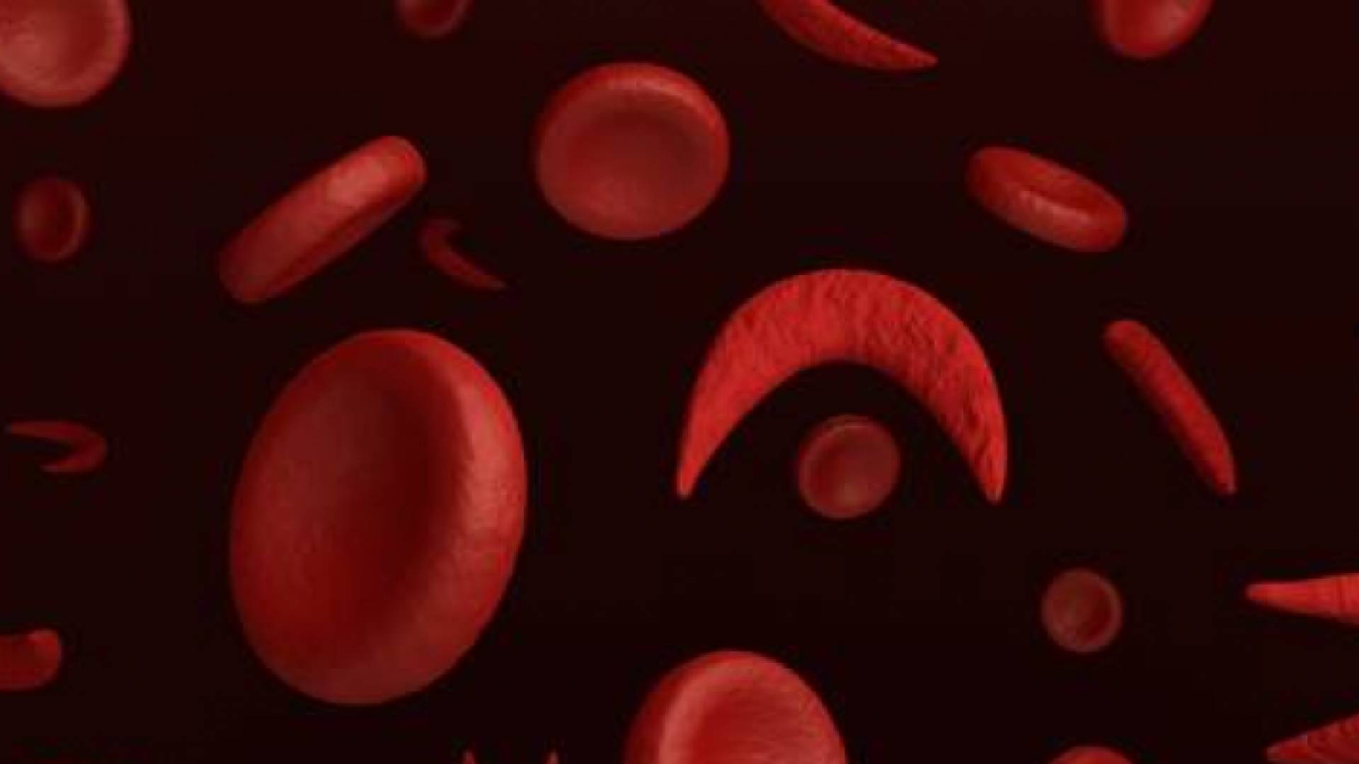 أمل جديد لمرضى الخلايا المنجلية