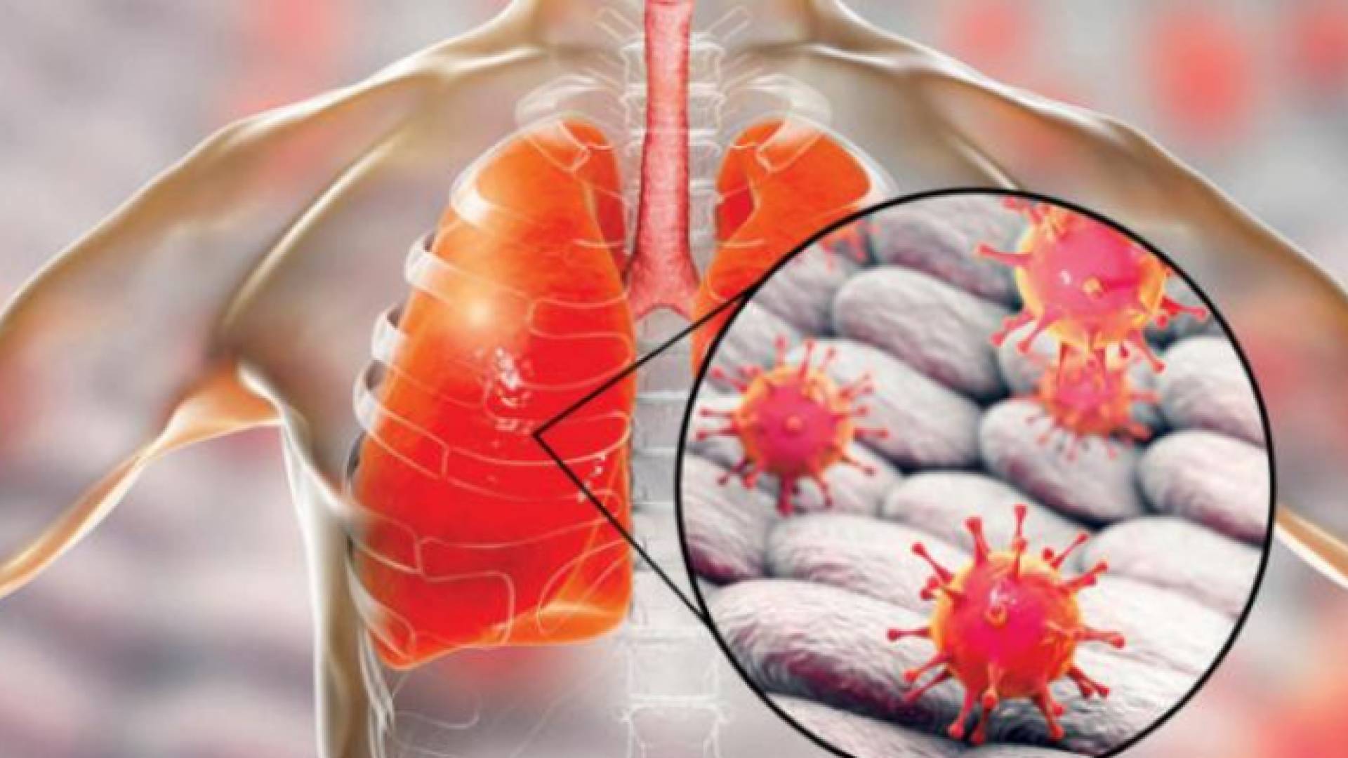 لالتهاب الرئوي هو أحد أعراض المرض