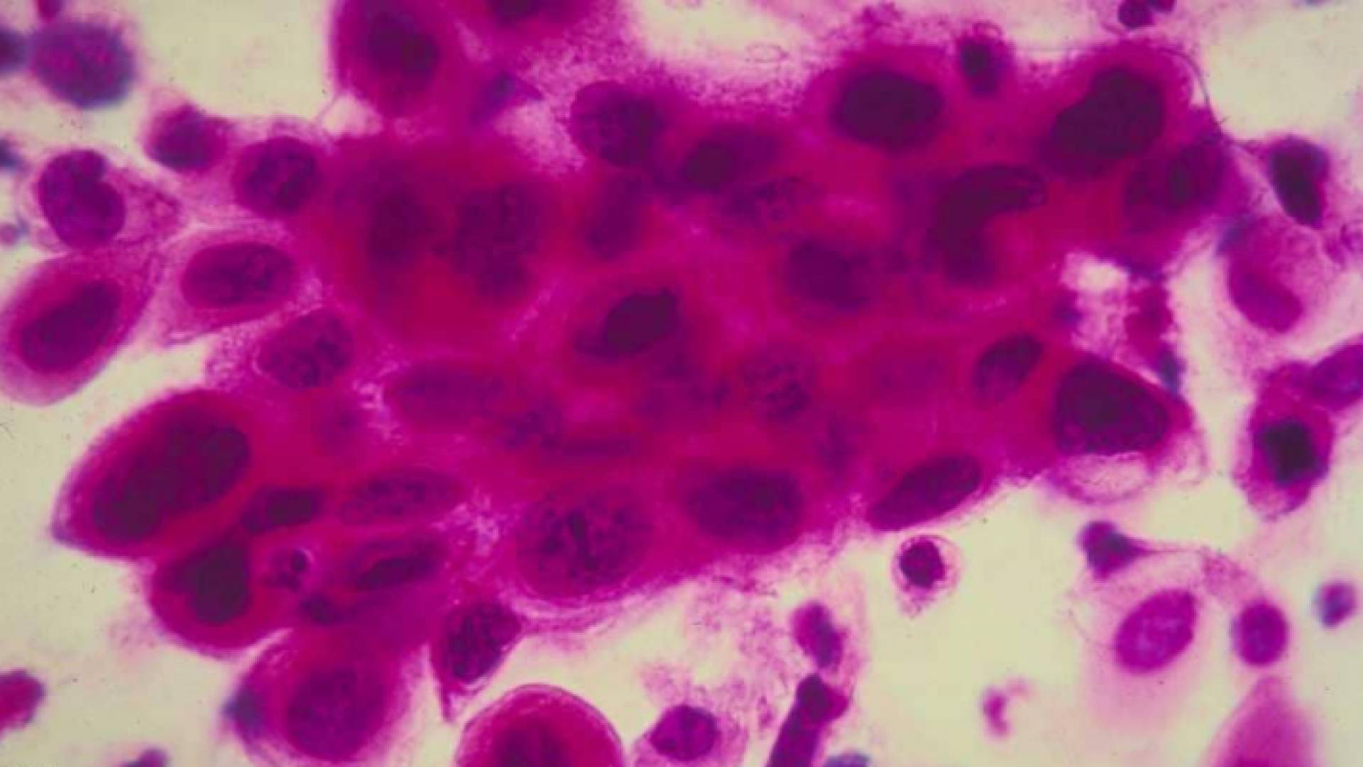 الخلية قادرة على القضاء على معظم أنواع من السرطان