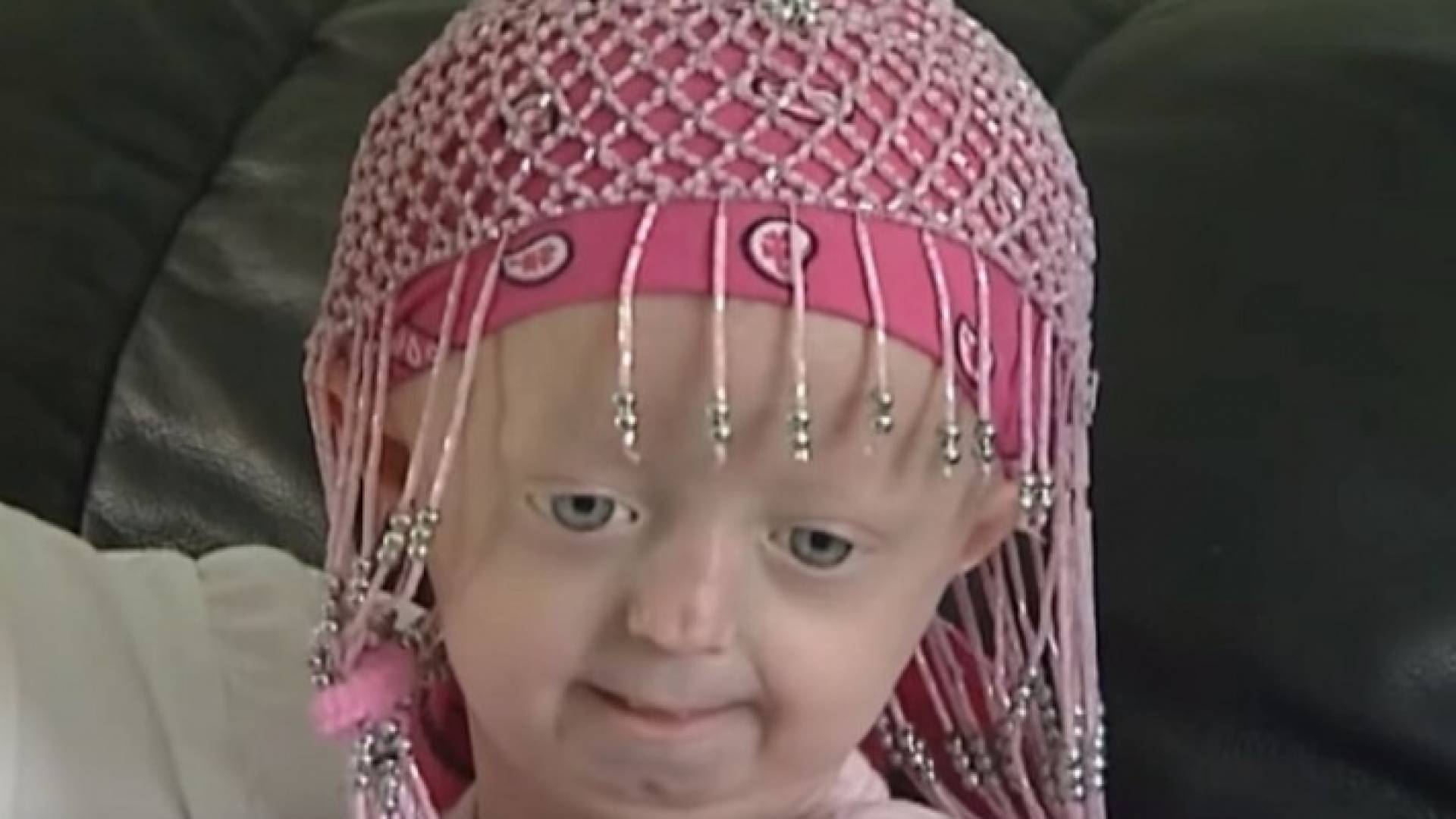 صورة لمصابة بمرض متلازمة بروجيريا