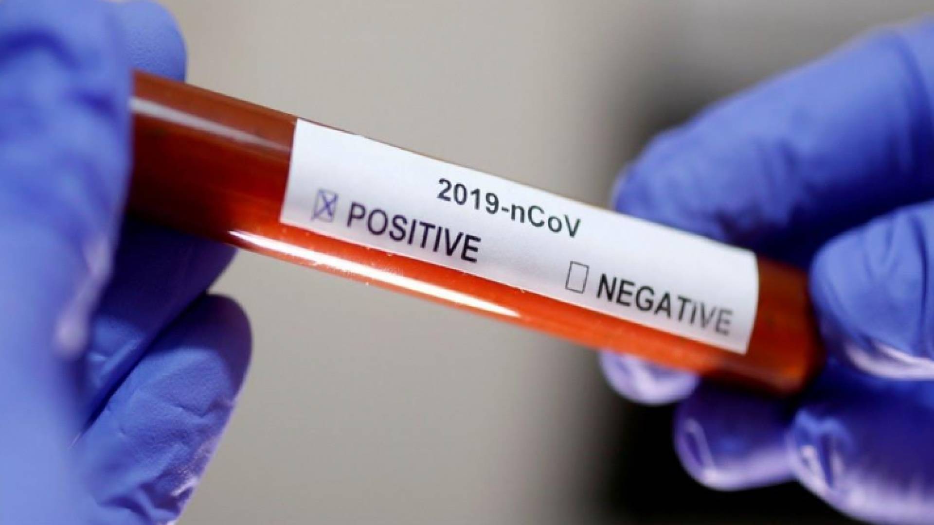 صحة البلقاء: سحب 29 عينة لمتعاملين مع مخالط لمصاب بالكورونا