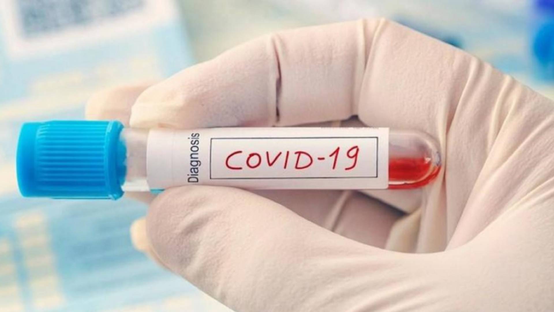 300 عينة لكوادر وعاملين في مركز حدود الكرامة سلبية