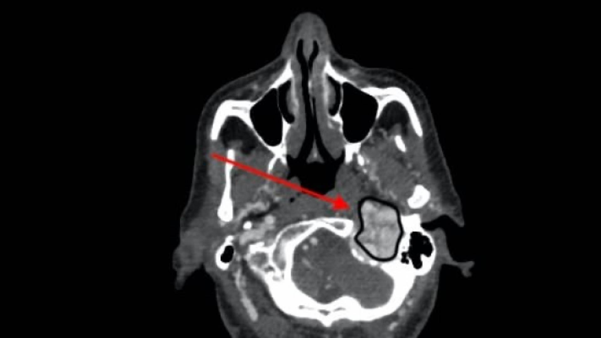 استئصال ورم وداجي دماغي لسيدة في مدينة الحسين الطبية