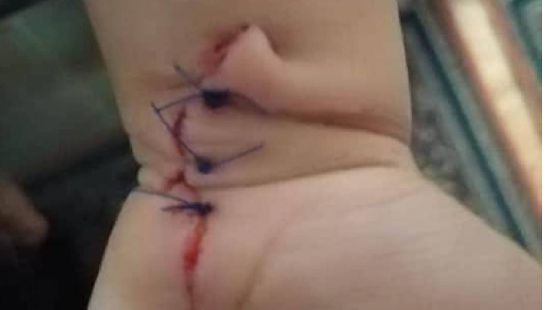 خطأ طبي بخياطة يد طفل في مستشفى اليرموك قد يتسبب بحدوث "اعاقة" له