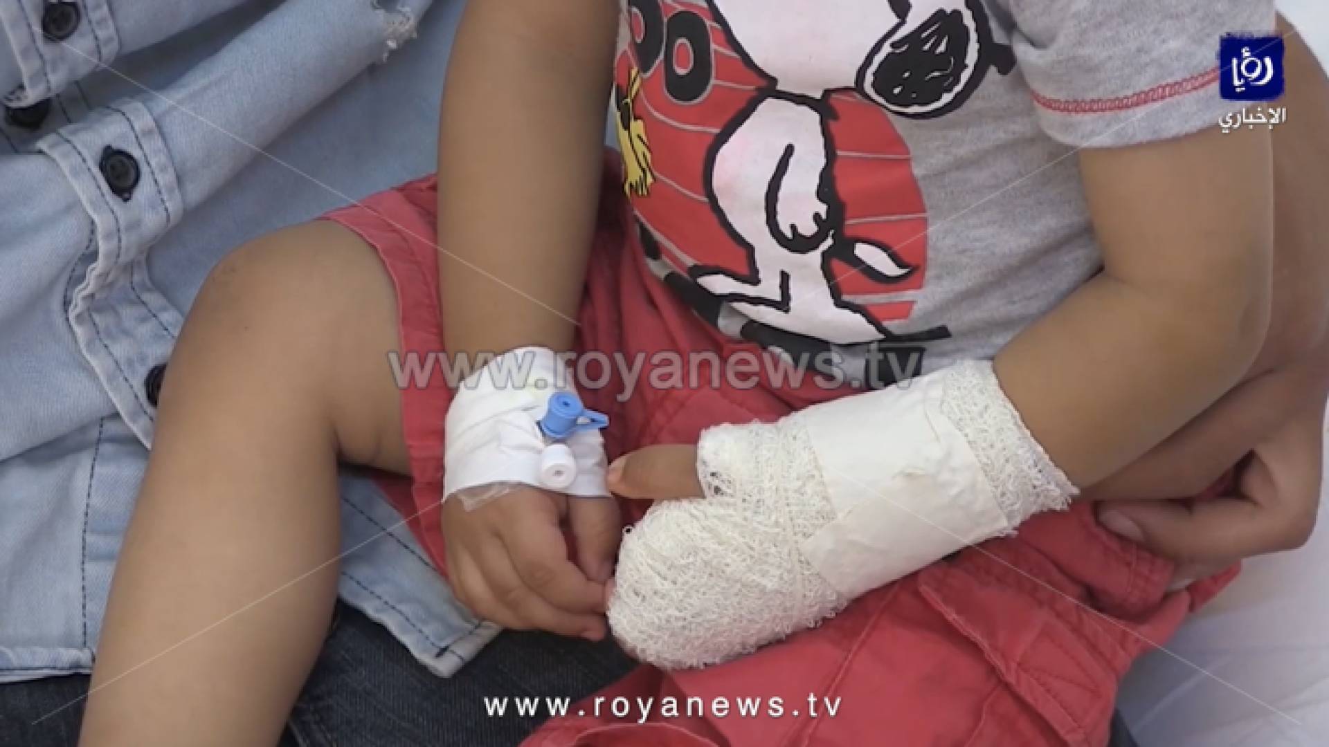 تفاصيل جديدة عن "خياطة يد طفل" في إربد.. المستشفى يلوم "زاوية الصورة"