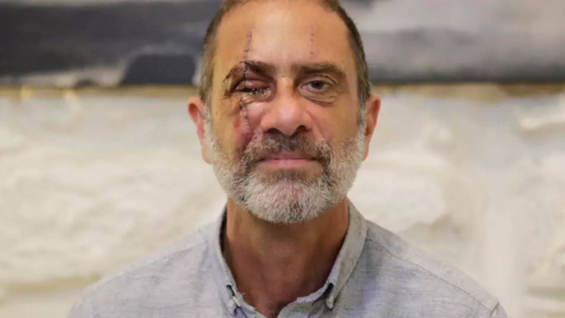 الطبيب النفسي روني مكتف (59 عاما) الذي فقد عينا بانفجار بيروت - ا ف ب