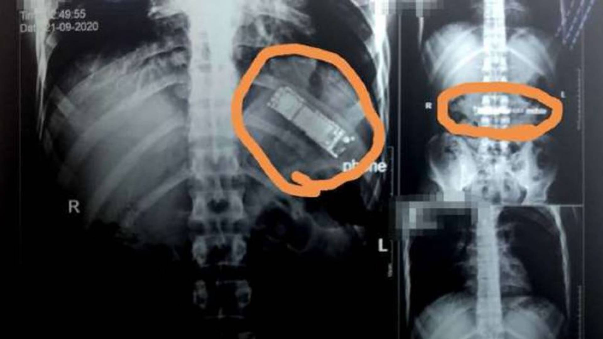 العثور على هاتف محمول في معدة مواطن مصري