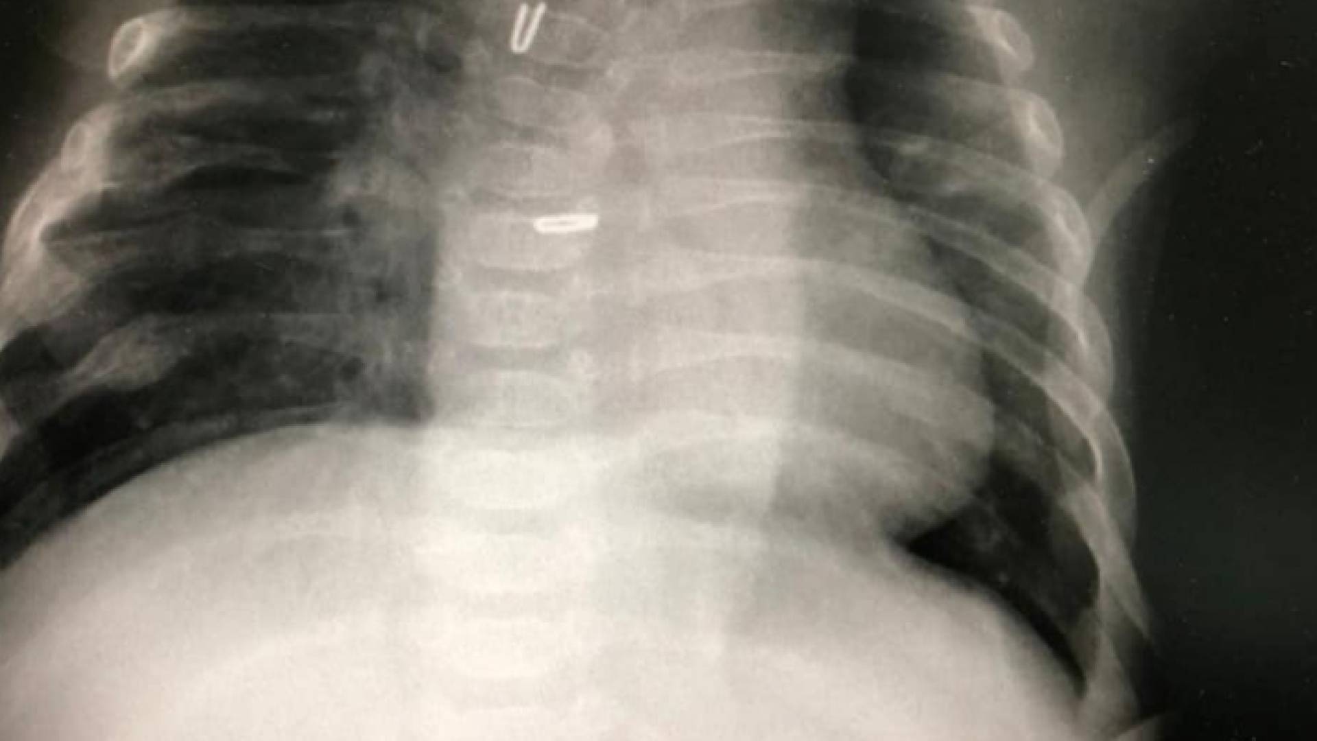 مستشفى الجامعة: إصلاح انسداد مريئي لطفل حديث الولادة