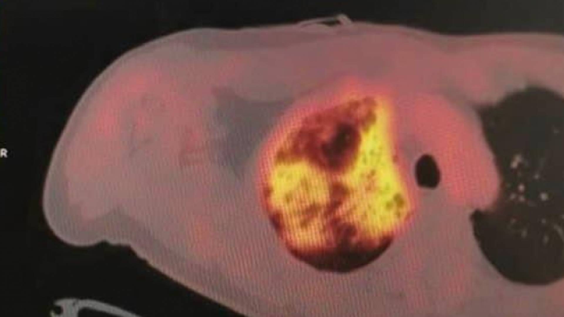 "النار المشتعلة" صورة تكشف تأثير كورونا على الرئة