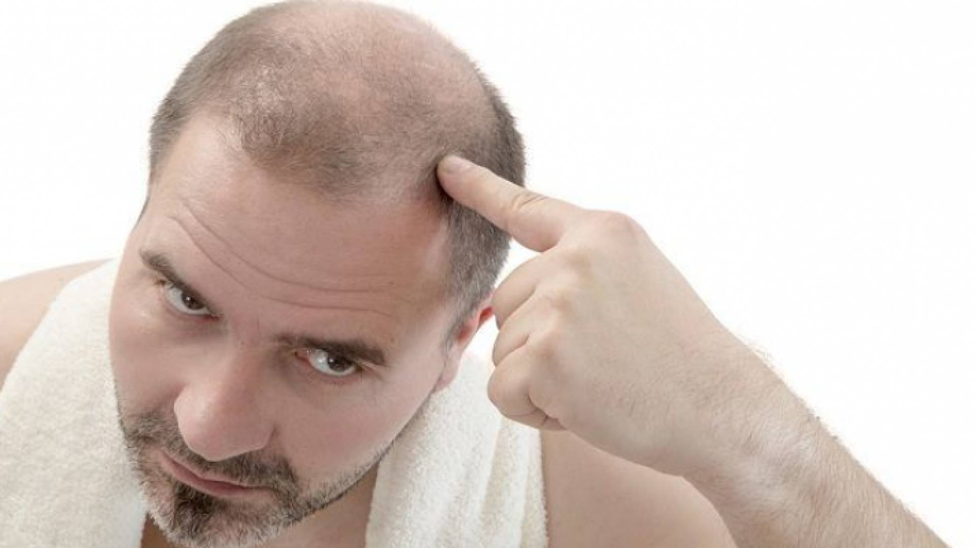 تساقط الشعر