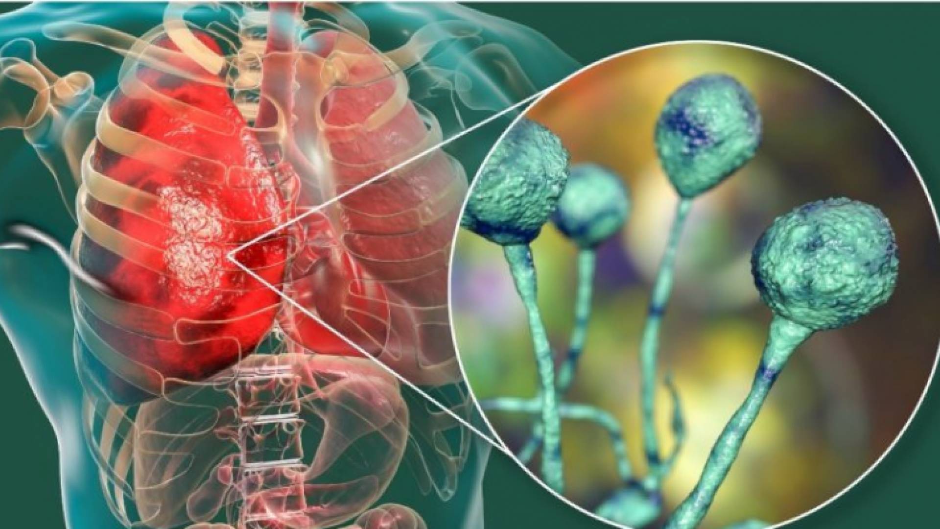 الفطر الأسود - تعبيرية