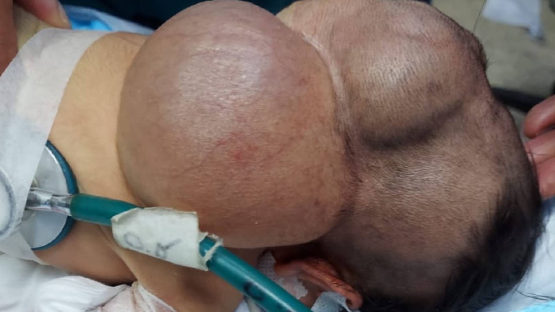رأس المولودة