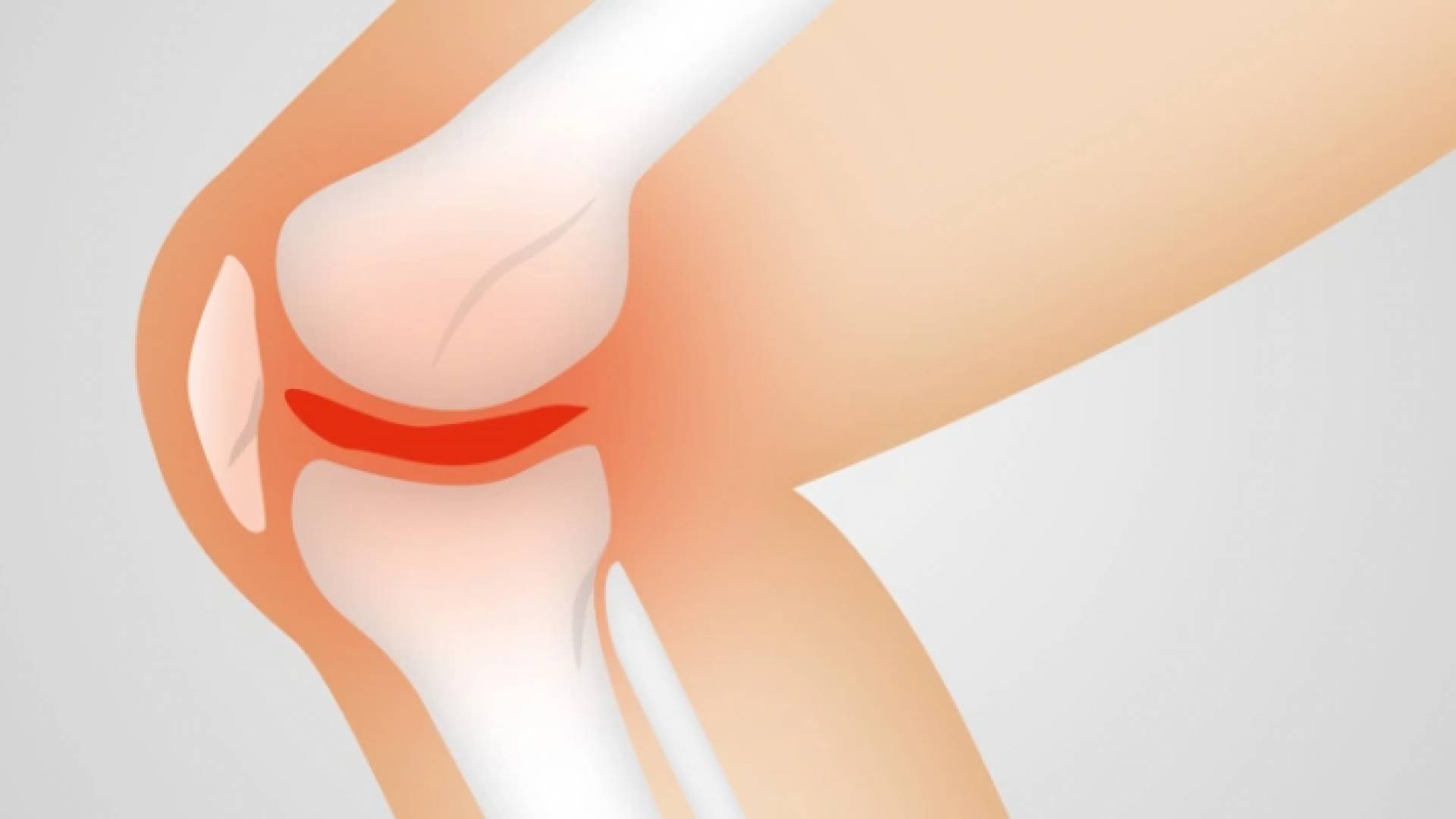 تآكل المفاصل - تعبيرية