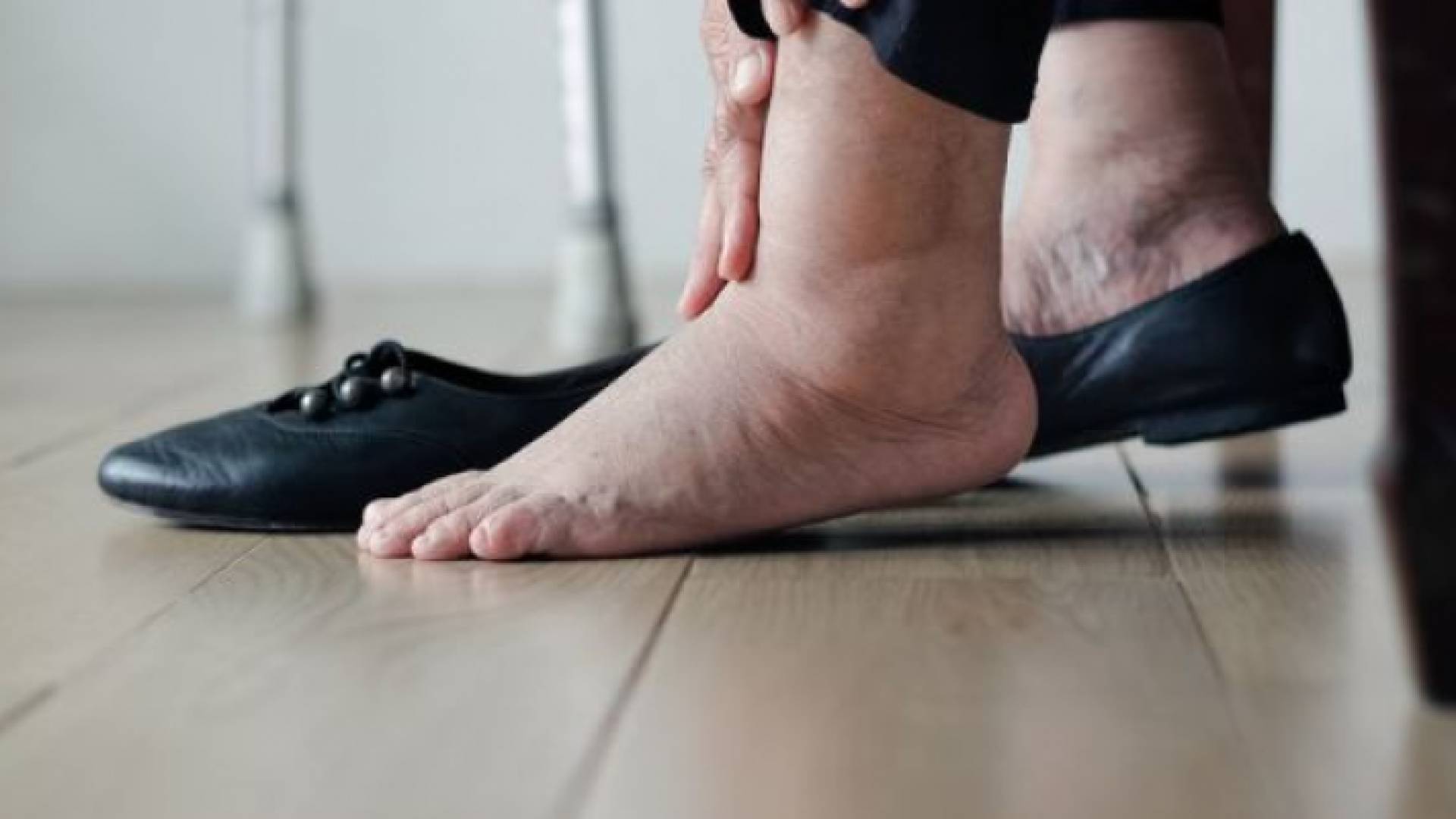 تورم القدمين - تعبيرية