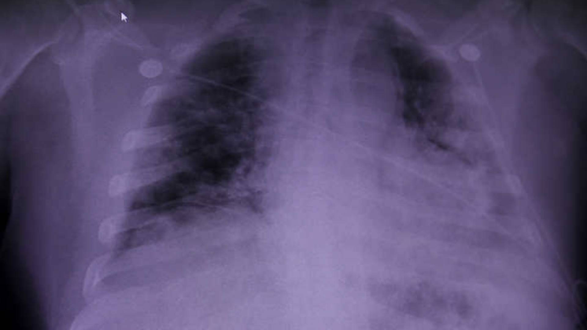 صورة أشعة للرئة