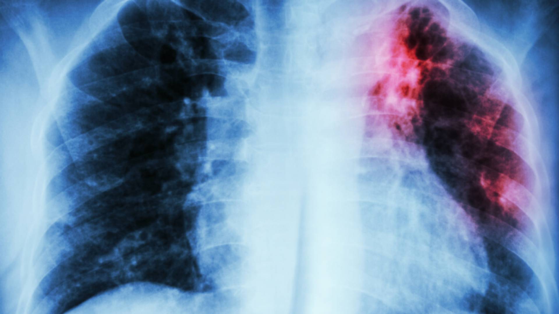 صورة أشعة للرئة