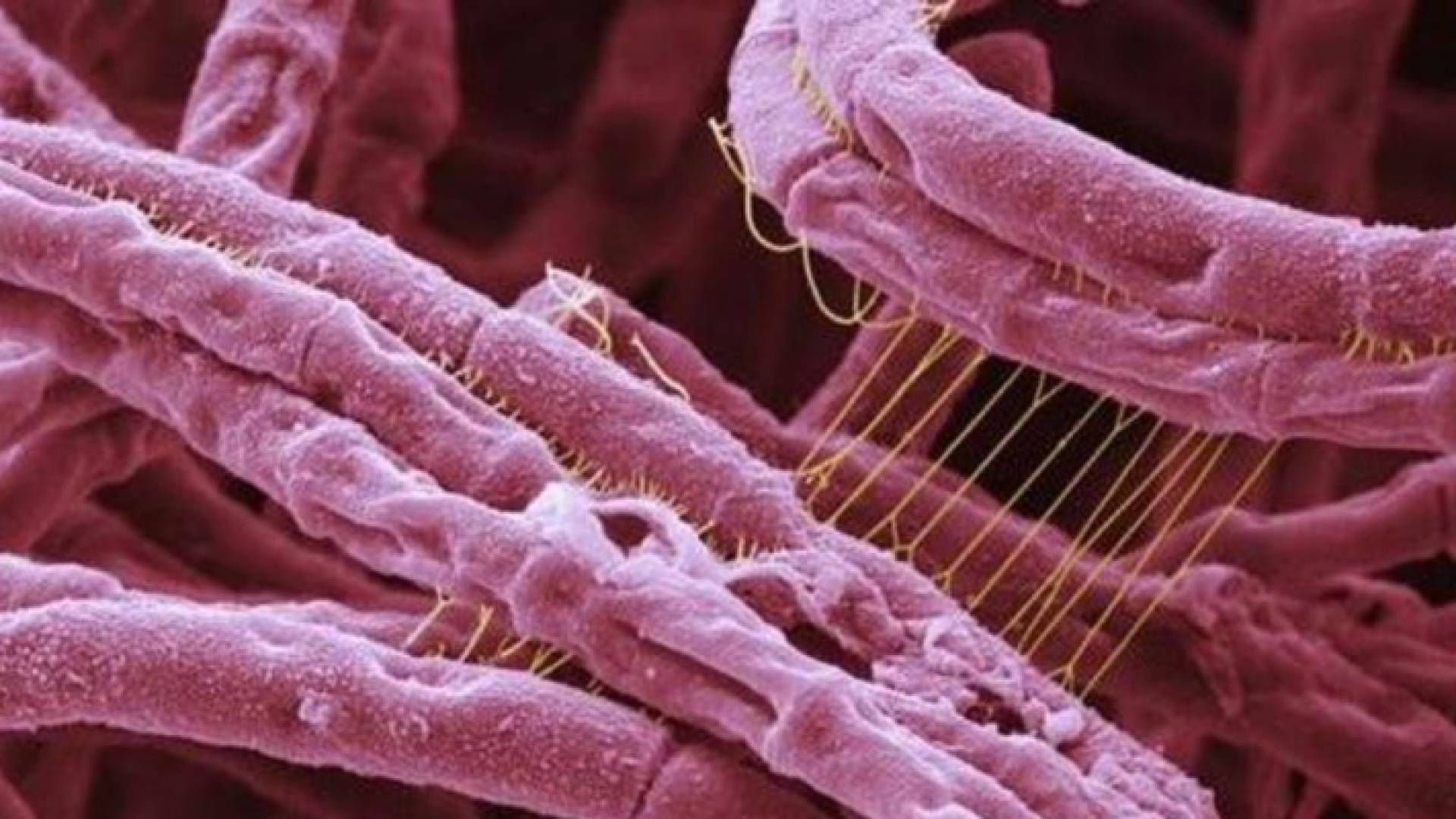 مرض الجمرة الخبيثة - تعبيرية