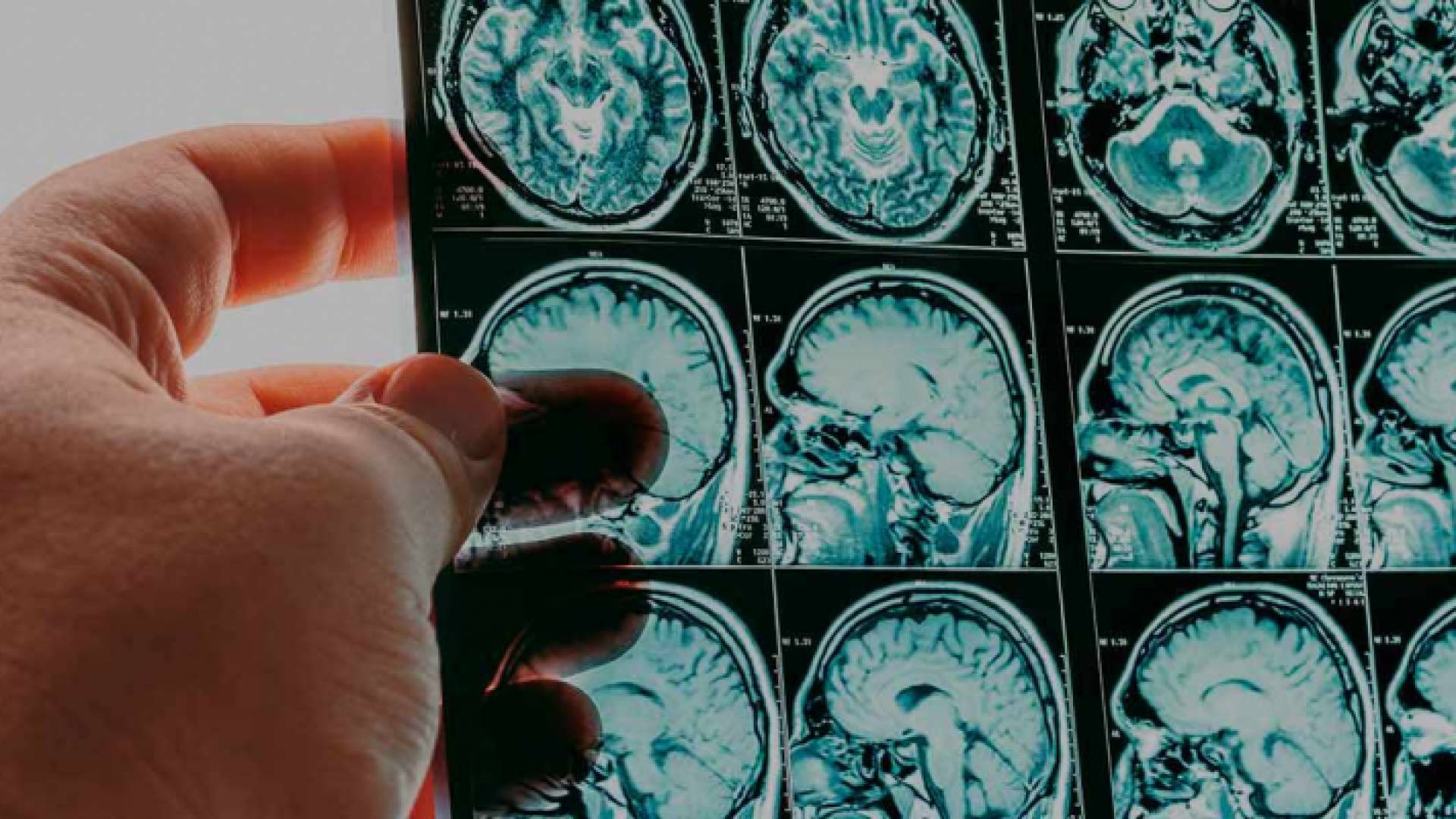 تقنية جديدة تبشر بالقضاء على الورم الأرومي الدبقي