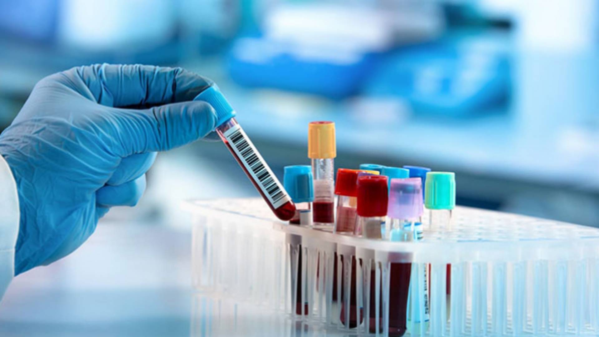 عينات دم مجهزة لاختبارها