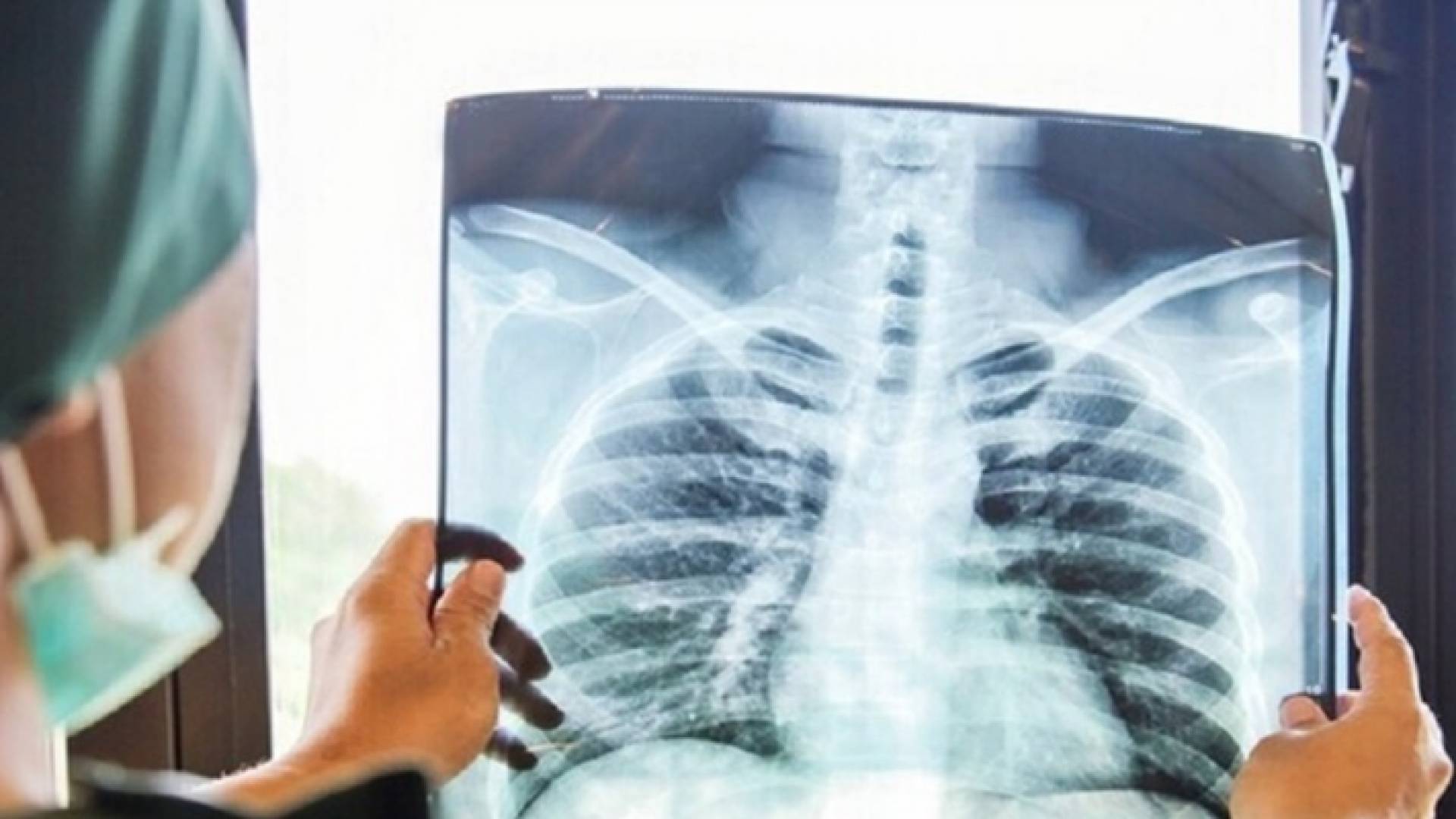 صورة أشعة لمريض بسرطان الرئة