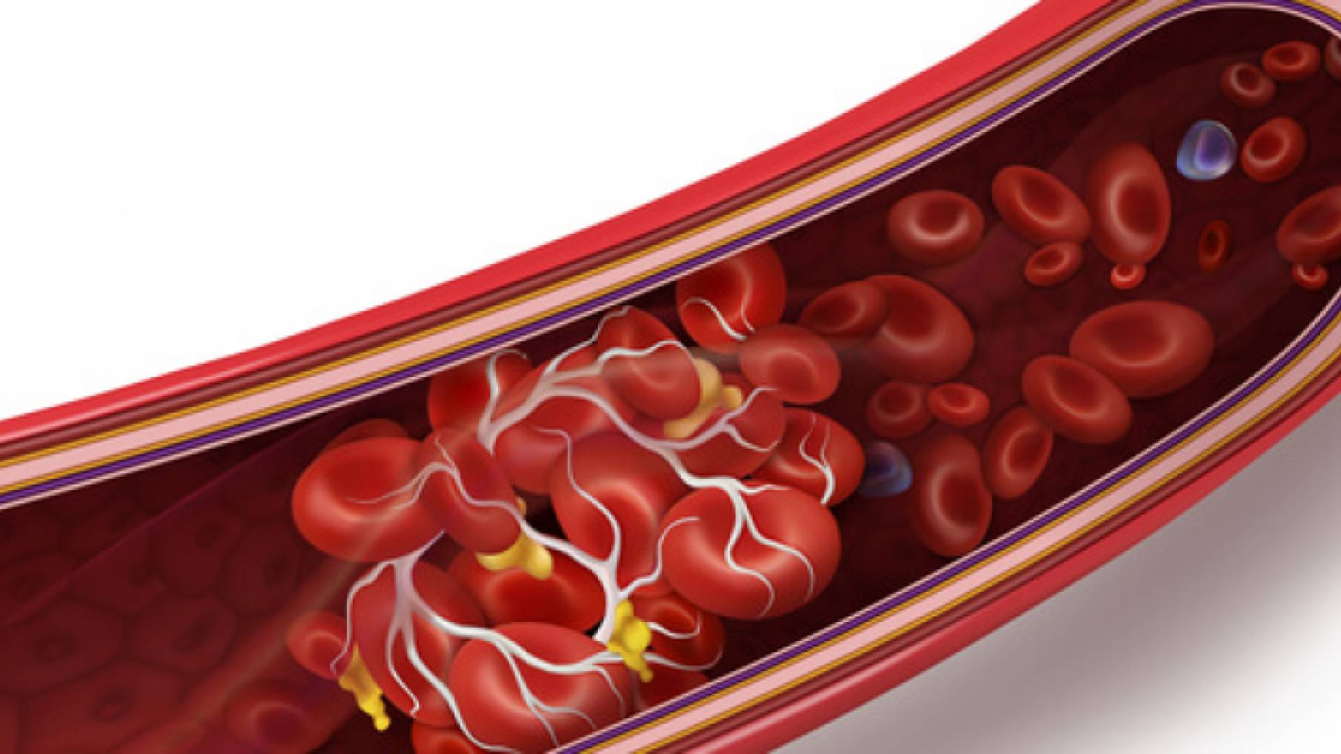 جلطات دموية - تعبيرية