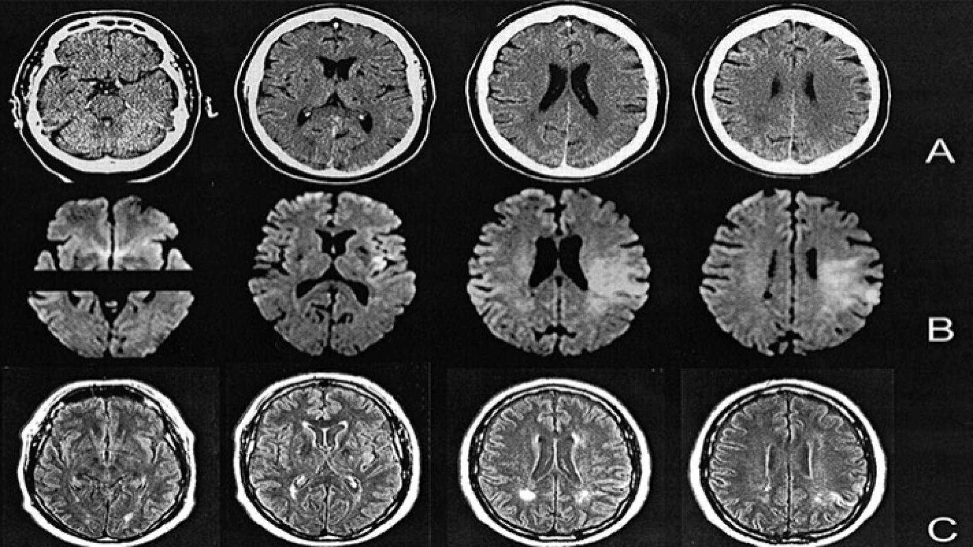 صورة طبقية للدماغ