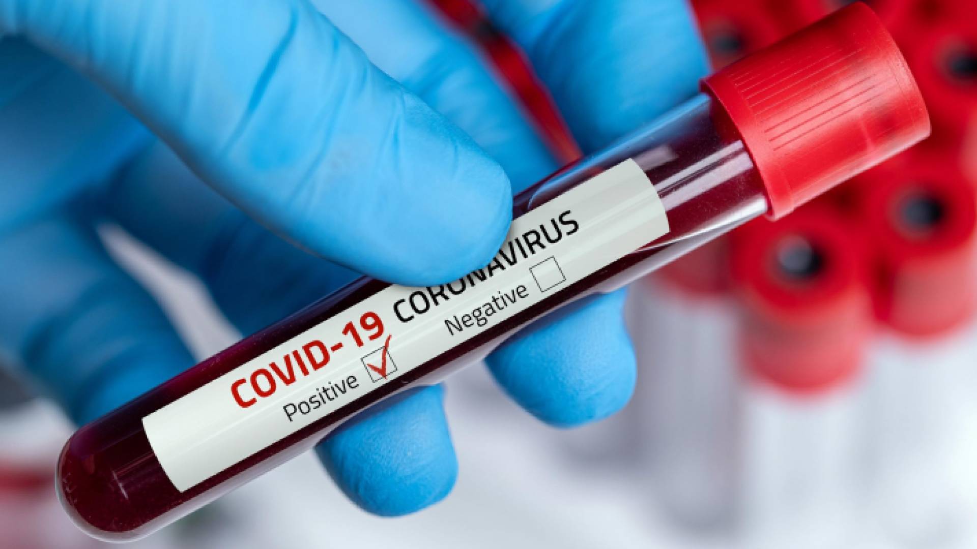 عينة فحص "بي سي آر"