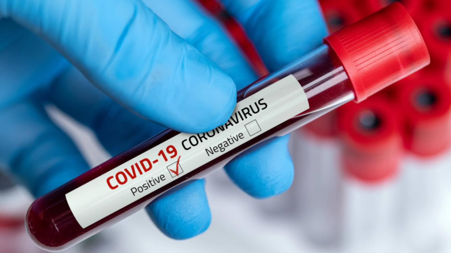 عينة فحص "بي سي آر"